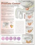 Understanding Prostate Cancer