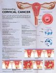 Understanding Cervical Cancer