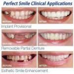 Cosmetic Overlay On The Upper Teeth – Perfect Smile Veneers