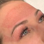 Plasma Skin Tightening Training One-on-one