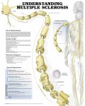 Understanding Multiple Sclerosis Anatomical Chart 9716