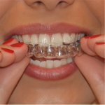 2PCS Moldable Mouth Guard For Teeth Grinding Clenching Bruxism At Night Anti Snoring Device Mouth Protection Custom Fit For Adul